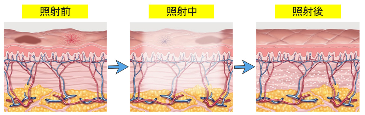 フォトフェイシャル施術