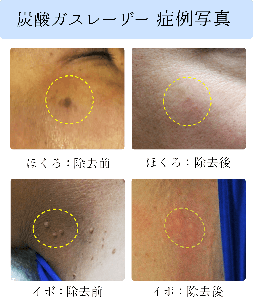 炭酸ガスレーザー症例写真｜イボ取りほくろ取り