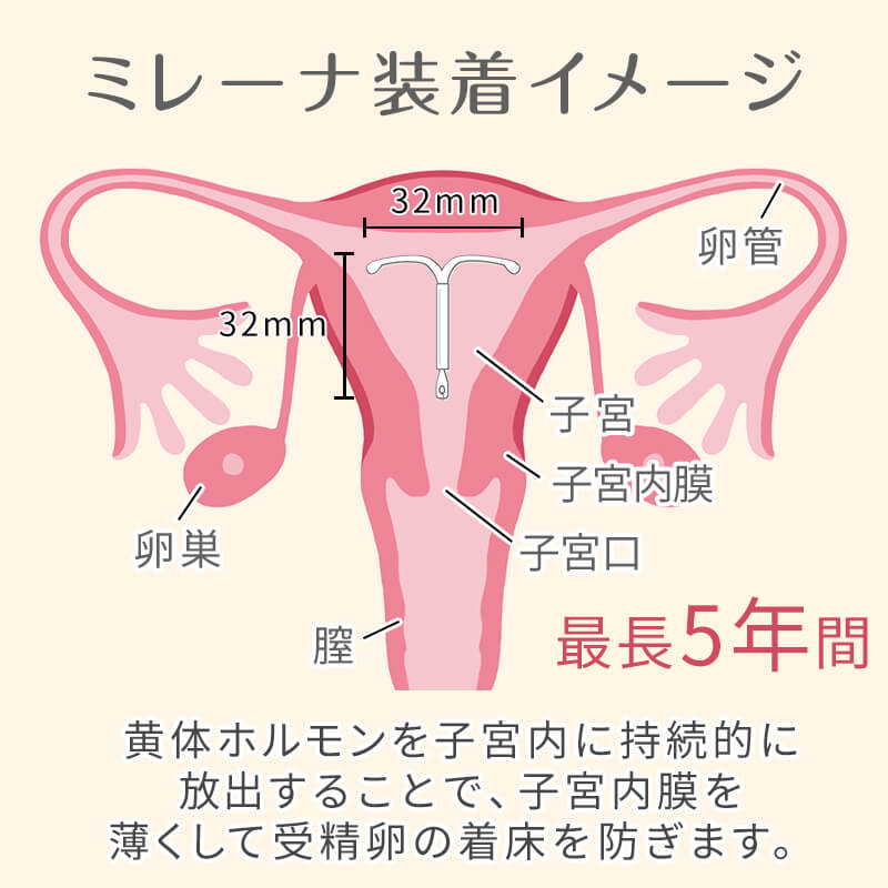 ミレーナの効果と挿入位置・サイズの図解