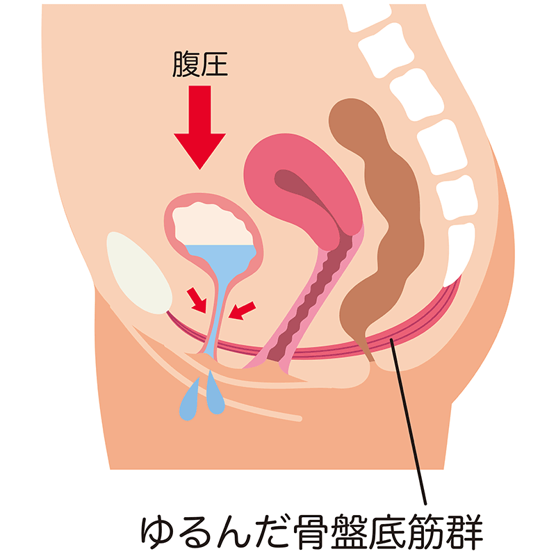 尿漏れの原因：ゆるんだ骨盤底筋群の図解