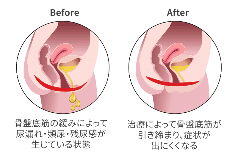 スターフォーマー効果図解