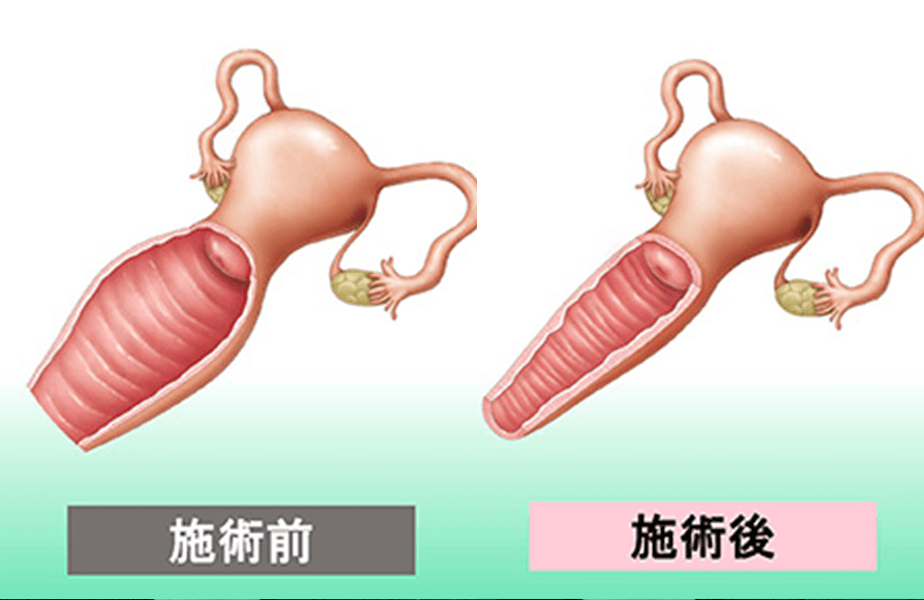 腟引き締め・産後ゆるみ