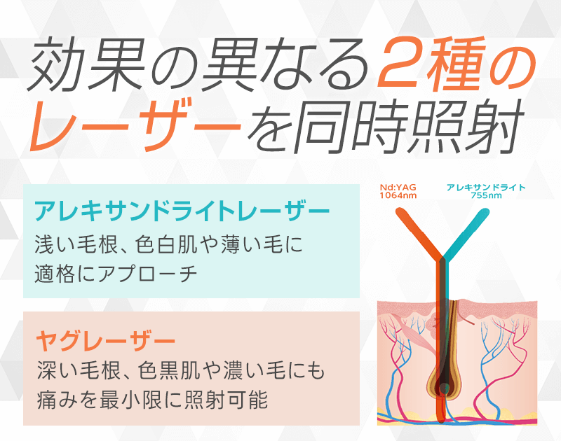 アレキサンドライトレーザーとYAGレーザーの2種類を同時に照射