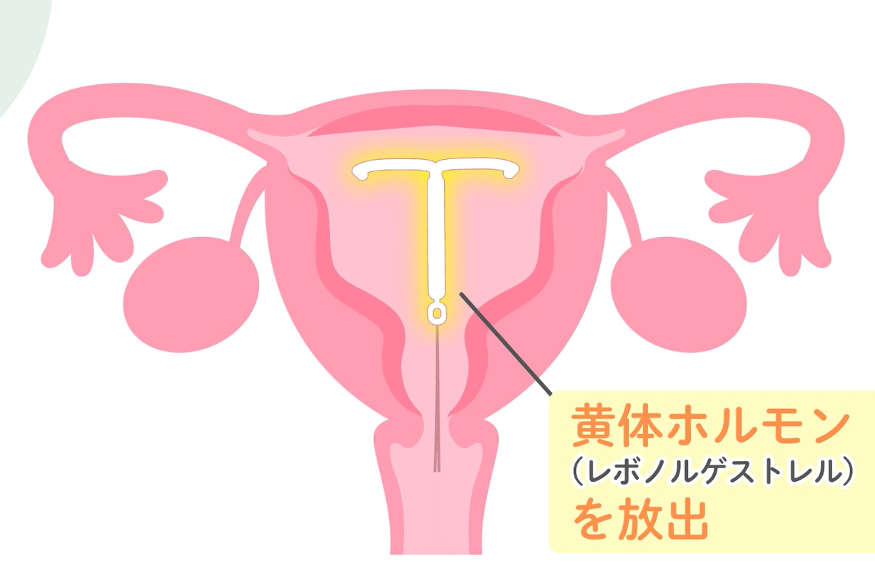 ミレーナで臭い軽減される仕組み