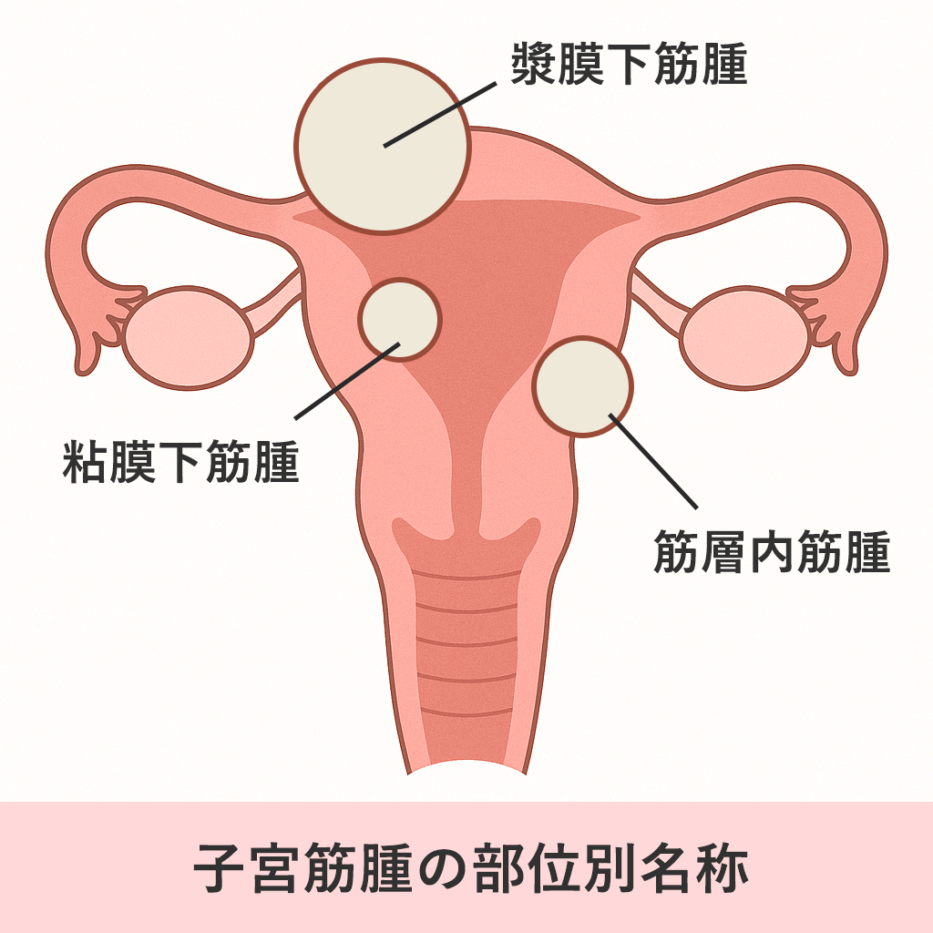子宮筋腫の位置イメージ（粘膜下・筋層内・漿膜下）