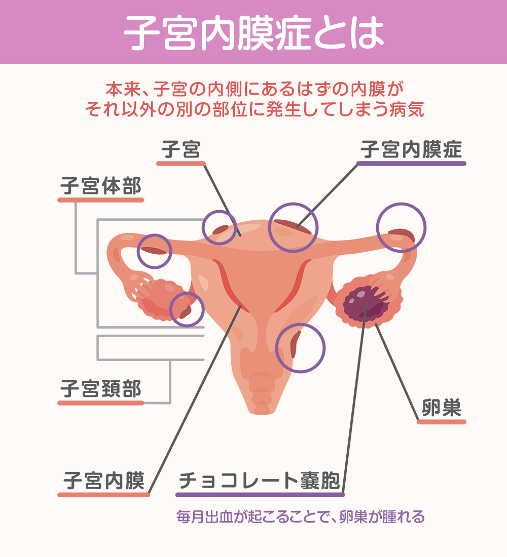 子宮内膜症とは