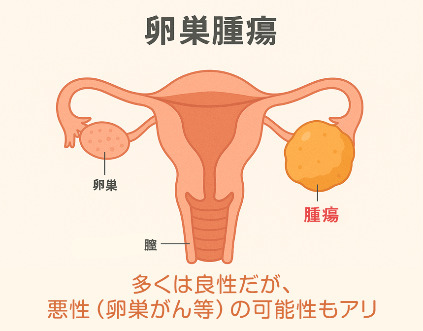 卵巣腫瘍とは