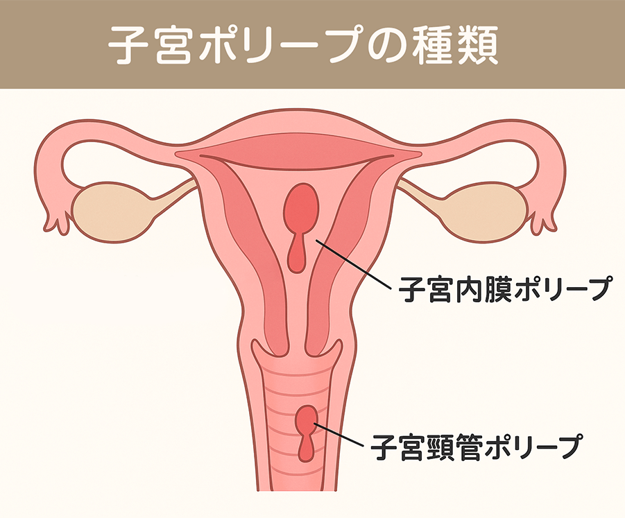 子宮ポリープとは