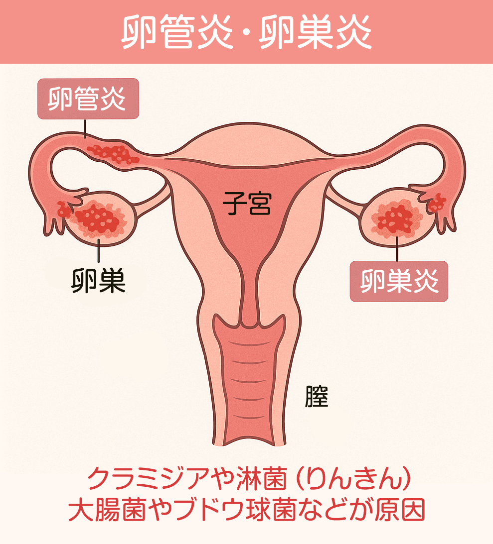 卵管炎・卵巣炎とは