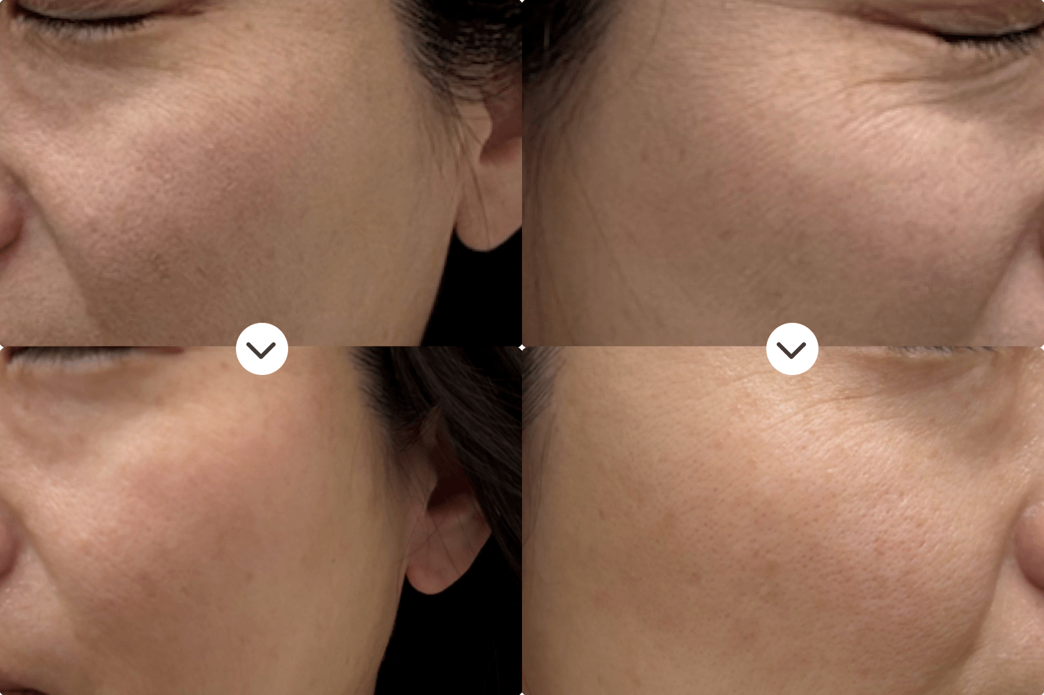 エレクトロポレーション症例写真術直後