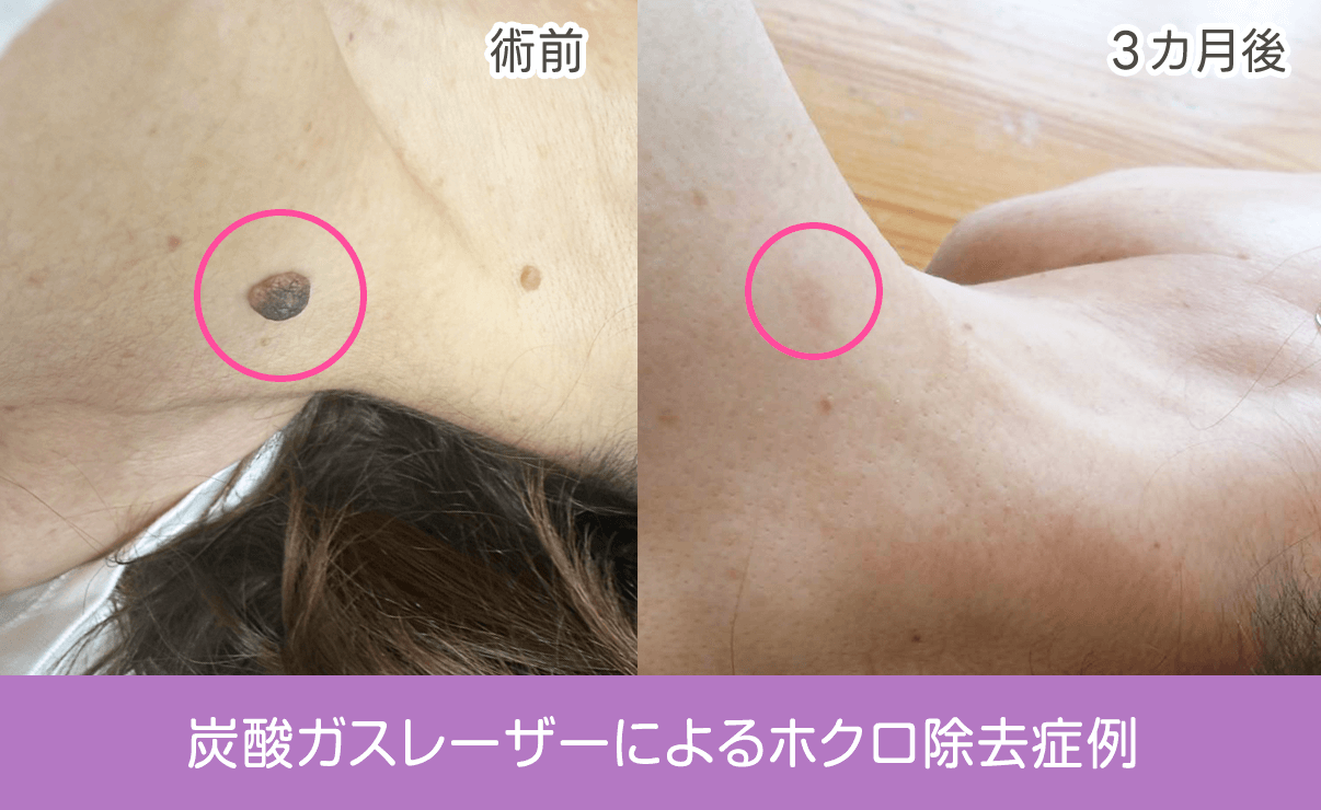 炭酸ガスレーザー症例写真｜首のイボ取りほくろ取り（大）