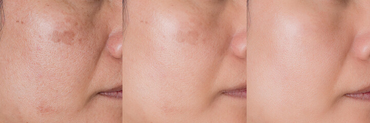 医師による手打ち注射