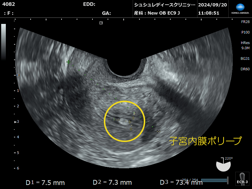 子宮内膜ポリープとは