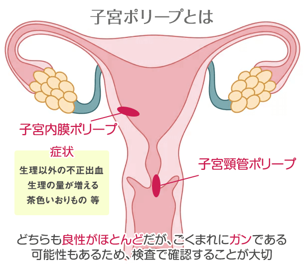 子宮ポリープとは