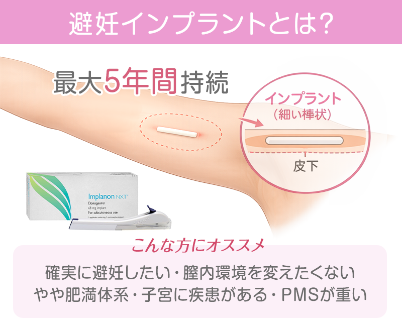 避妊インプラントとは