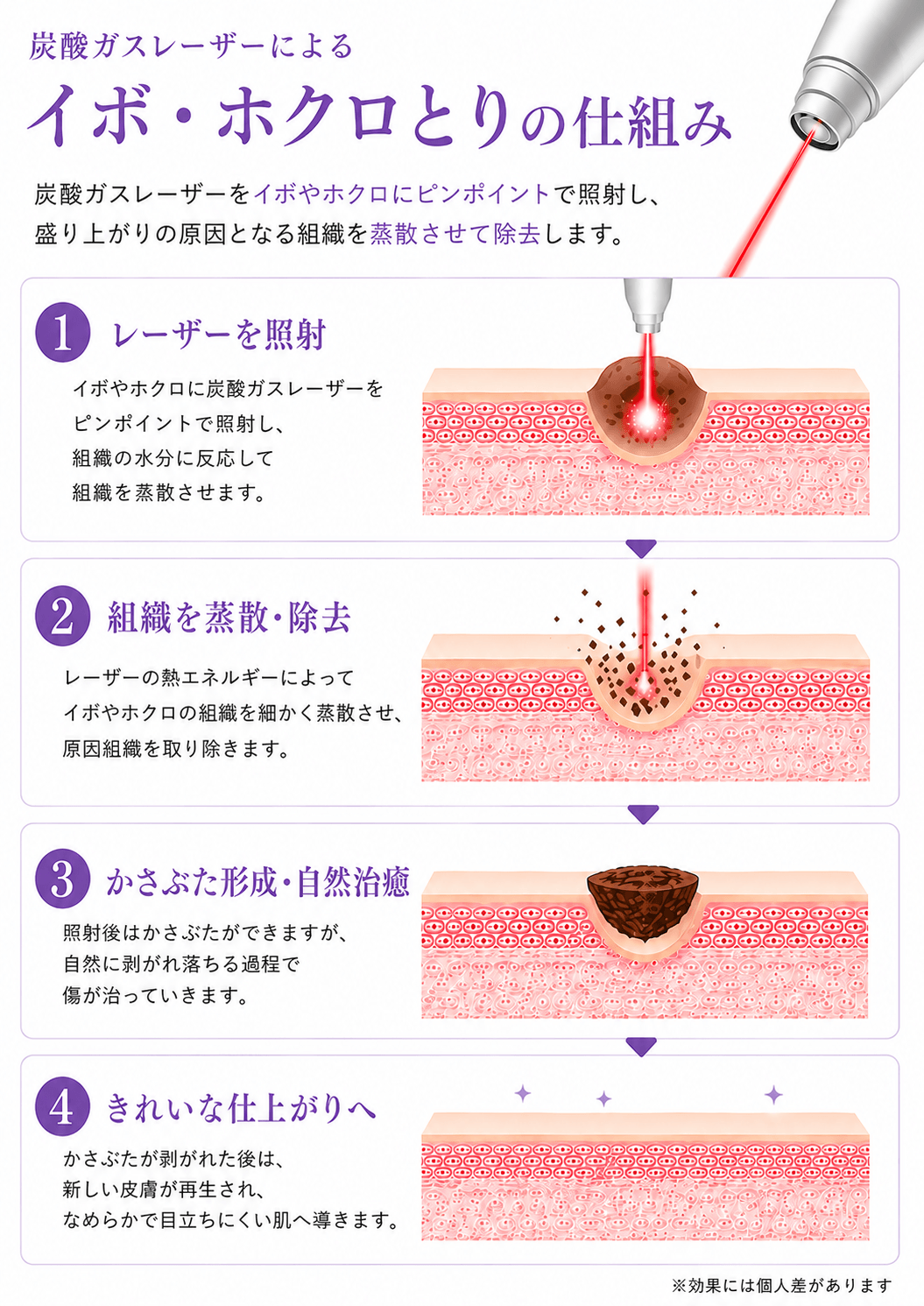 炭酸ガスレーザーの仕組み