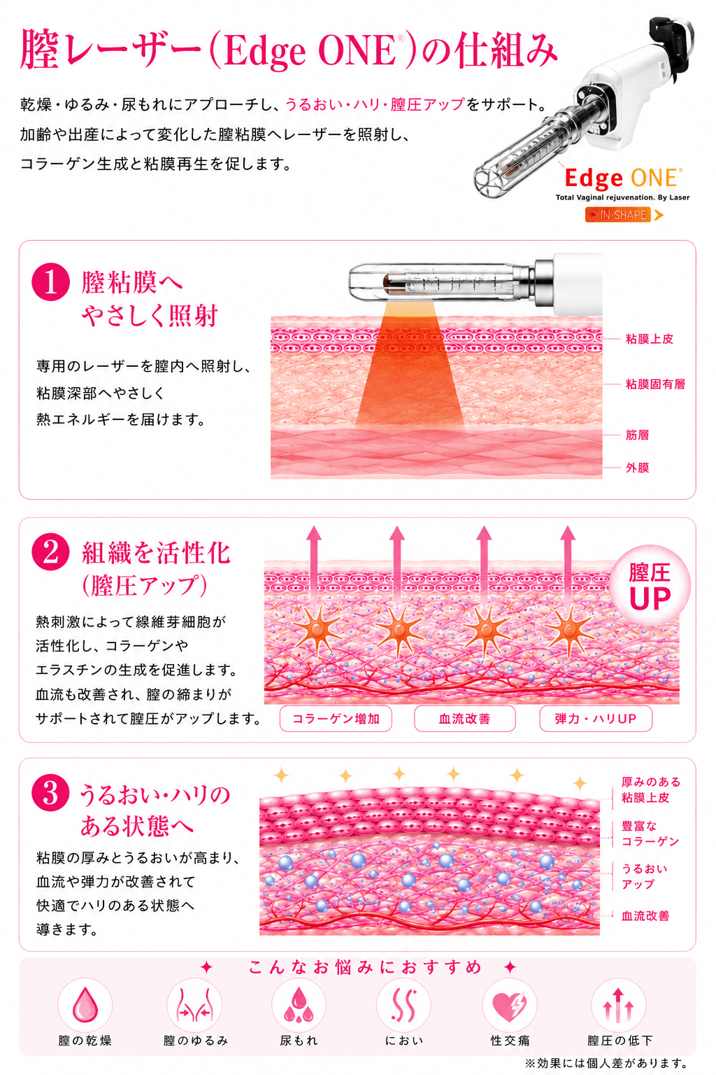 膣レーザーエッジワンの効果・仕組み