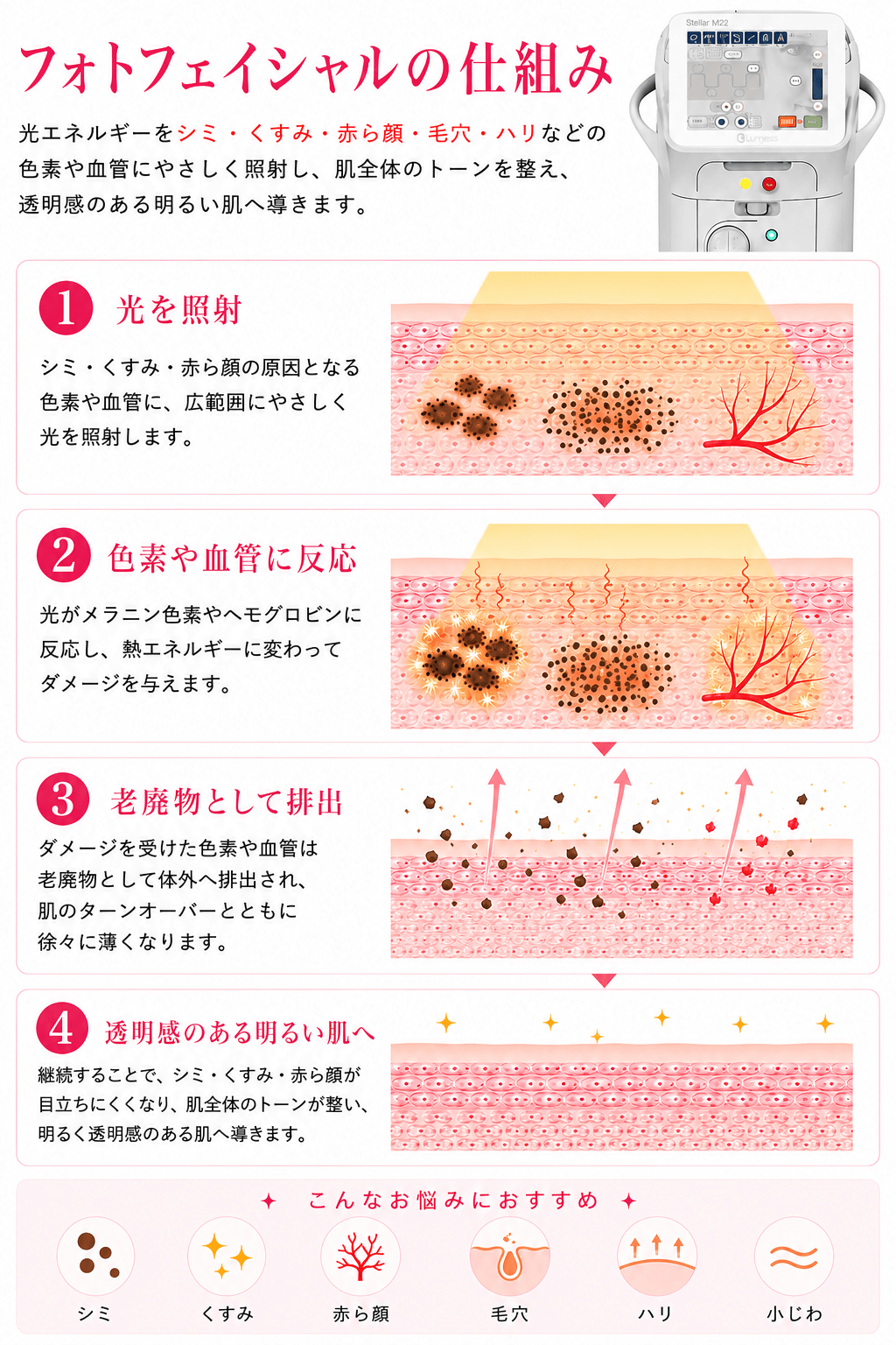 フォトフェイシャルステラM22の効果・仕組み